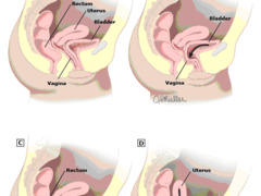 Pelvic organ prolapse causes, symptoms and treatment