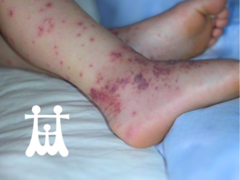 Boy with purple legs and blood in stools.